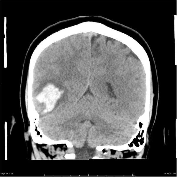File:Cerebral hemorrhage secondary to arteriovenous malformation (Radiopaedia 33497-34561 Coronal non-contrast 37).jpg