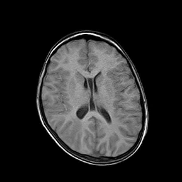 File:Cerebral tuberculoma (Radiopaedia 41152-43932 Axial T1 13).jpg