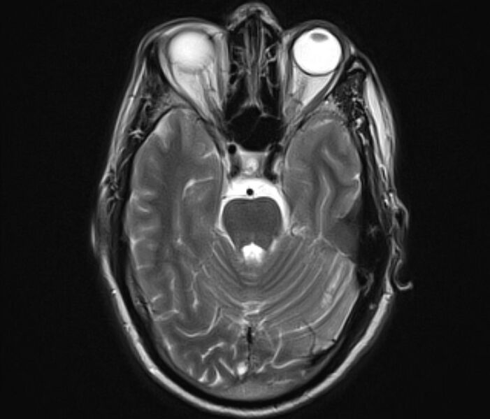 File:Cerebral venous thrombosis (Radiopaedia 71207-81504 Axial T2 10).jpg