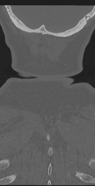 File:Cervical canal stenosis - OPLL and osteophytes (Radiopaedia 47329-51910 Coronal bone window 70).png
