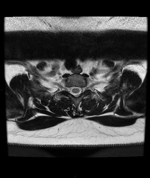 File:Cervical disc prolapse (Radiopaedia 80258-93598 Axial T2 86).jpg