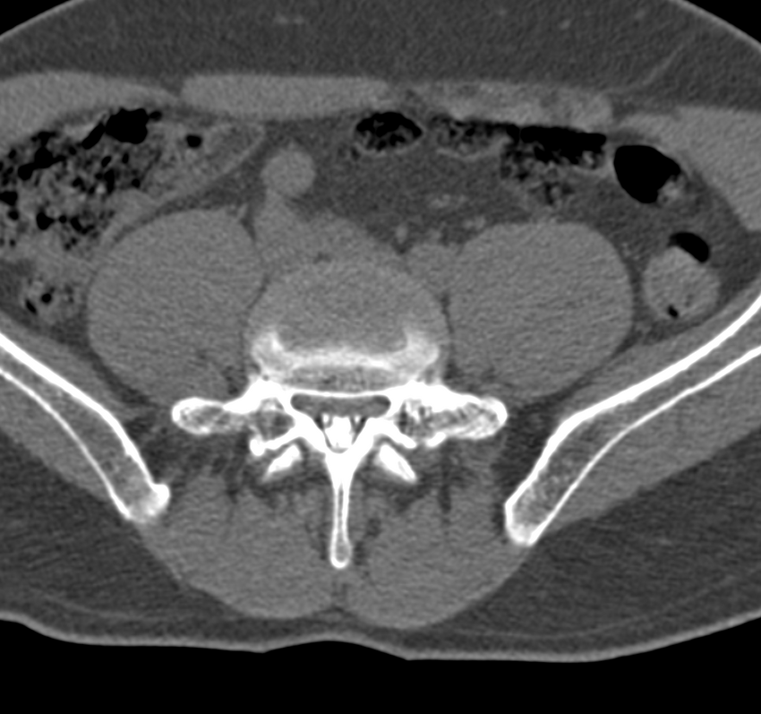 Cervical dural CSF leak on MRI and CT treated by blood patch (Radiopaedia 49748-54996 B 113).png