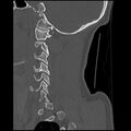 Cervical flexion teardrop fracture with cord hemorrhage (Radiopaedia 32497-33454 Sagittal bone window 11).jpg