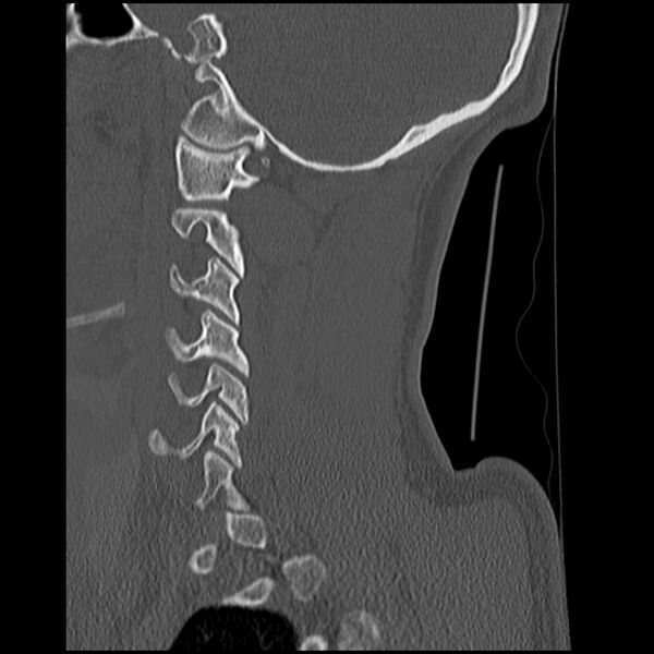 File:Cervical flexion teardrop fracture with cord hemorrhage (Radiopaedia 32497-33454 Sagittal bone window 11).jpg