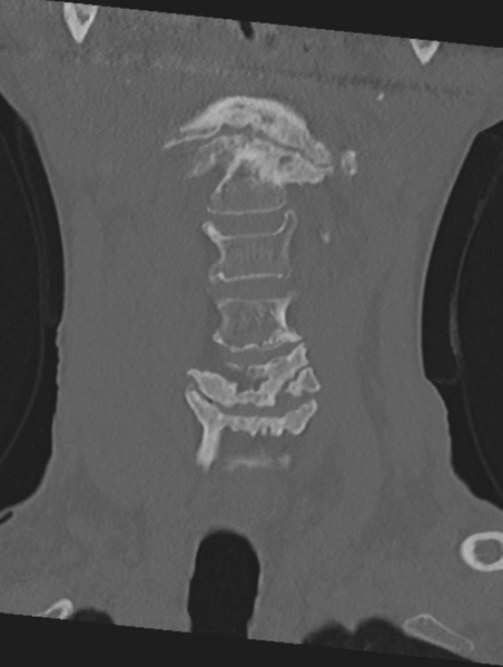 File:Cervical spondylolysis (Radiopaedia 49616-54811 Coronal bone window 11).png