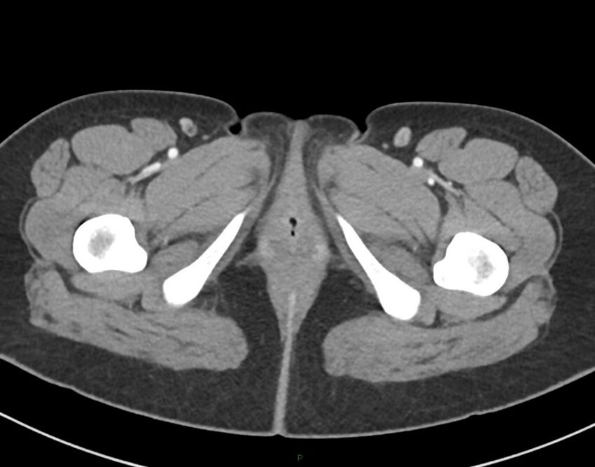 Cesarean scar endometriosis (Radiopaedia 82925-97262 A 94).jpg