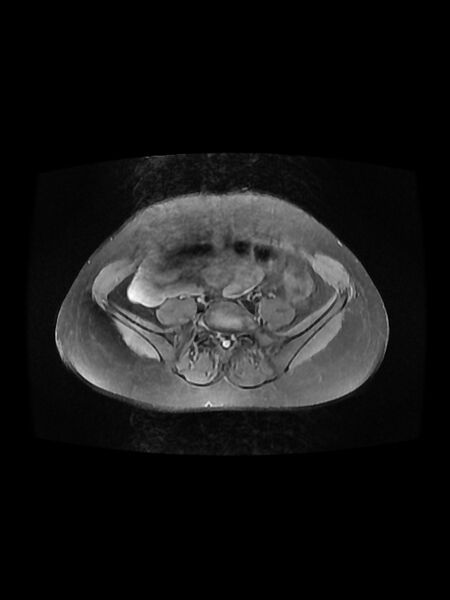 File:Cesarean section scar endometrioma (Radiopaedia 56569-63297 Axial PD fat sat 6).jpg