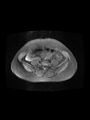 Cesarean section scar endometrioma (Radiopaedia 56569-63297 Axial PD fat sat 6).jpg