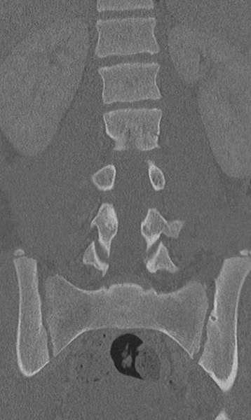 File:Chance fracture (Radiopaedia 40360-42912 Coronal bone window 37).png
