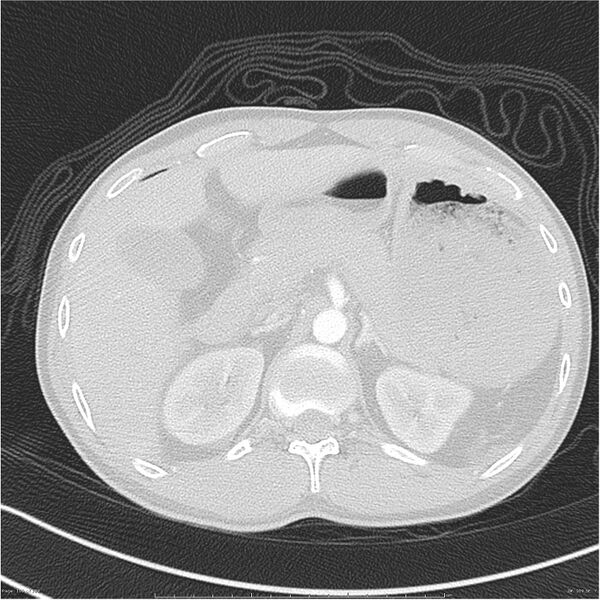 File:Chest and abdomen multi-trauma (Radiopaedia 26294-26425 lung window 109).jpg