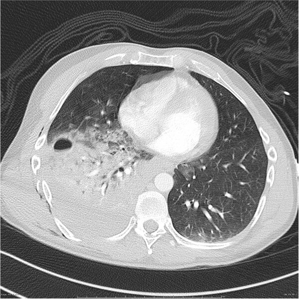 File:Chest and abdomen multi-trauma (Radiopaedia 26294-26425 lung window 69).jpg