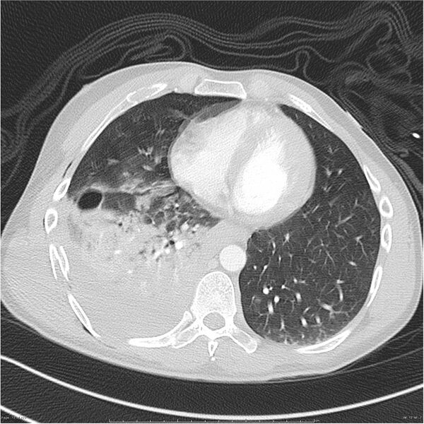 File:Chest and abdomen multi-trauma (Radiopaedia 26294-26425 lung window 72).jpg