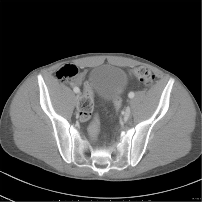 Chest and abdomen multi-trauma (Radiopaedia 26294-26426 A 70).jpg