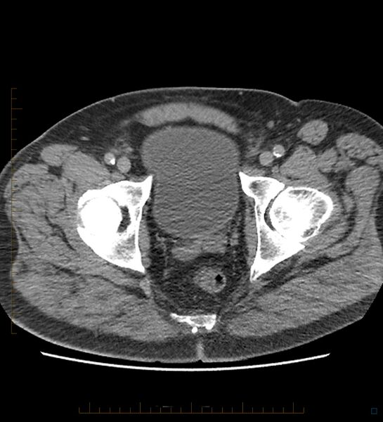 File:Chicken bone in anal canal (Radiopaedia 51490-57253 Axial non-contrast 4).jpg