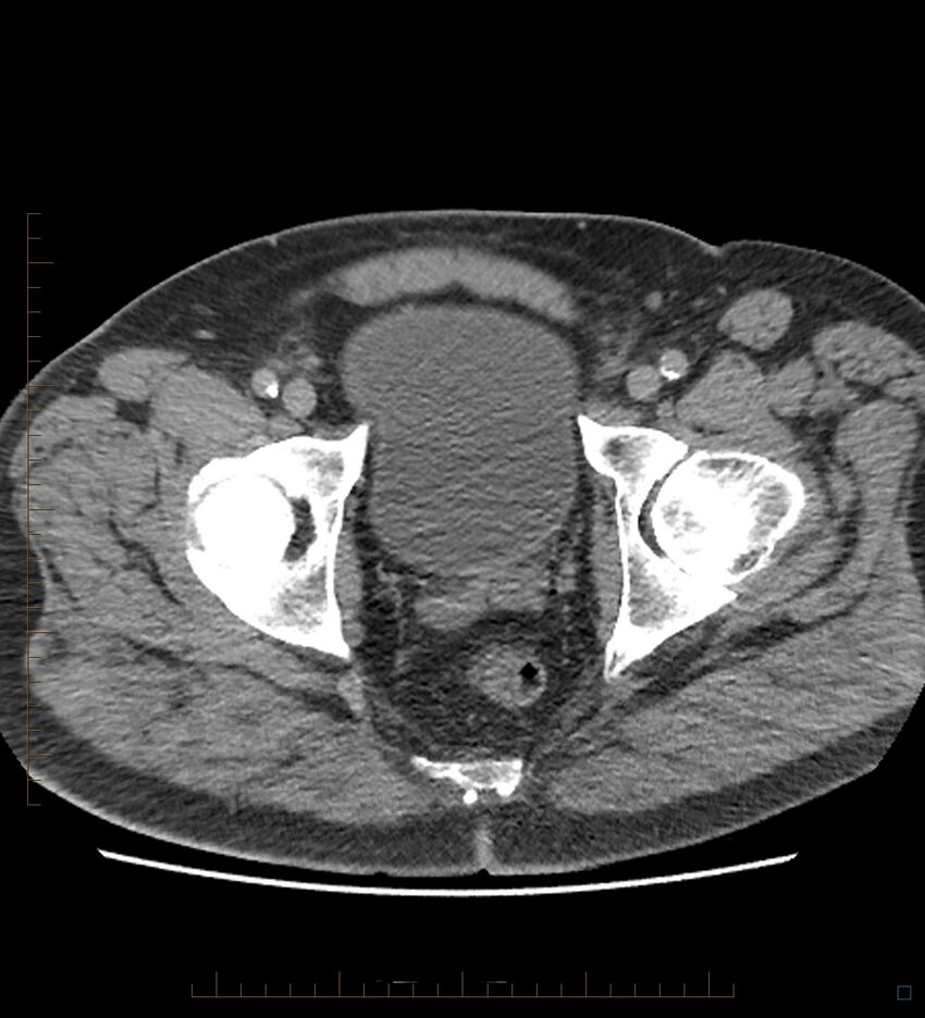 Chicken bone in anal canal (Radiopaedia 51490-57253 Axial non-contrast 4).jpg