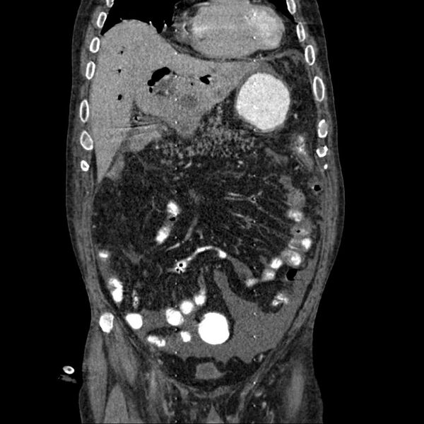 File:Cholangitis and abscess formation in a patient with cholangiocarcinoma (Radiopaedia 21194-21100 C 7).jpg