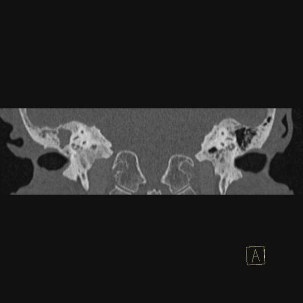 File:Cholesteatomatous chronic otitis (Radiopaedia 14993-14911 Coronal bone window 2).JPEG