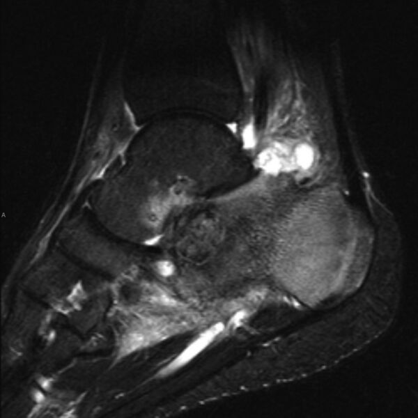 File:Chondroblastoma- calcaneum (Radiopaedia 10337-10859 Sagittal T2 fat sat 1).jpg