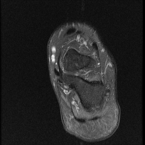 File:Chondroblastoma - midfoot (Radiopaedia 64831-73765 E 3).jpg
