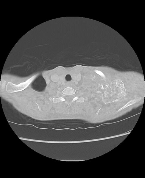 File:Chondrosarcoma (Radiopaedia 79427-92532 Axial lung window 2).jpg