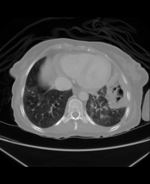 File:Chondrosarcoma (Radiopaedia 79427-92535 Axial lung window 40).jpg