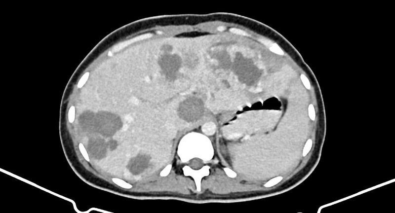 File:Choriocarcinoma liver metastases (Radiopaedia 74768-85766 A 56).jpg