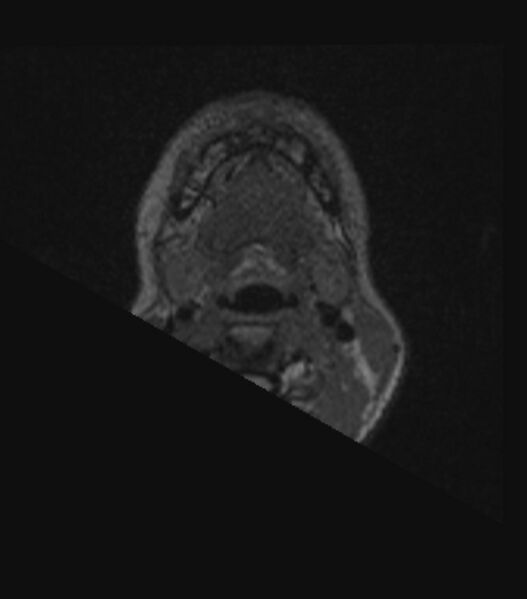File:Choroid plexus carcinoma (Radiopaedia 91013-108553 Axial FLAIR C+ 18).jpg