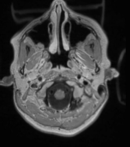 File:Choroid plexus carcinoma (Radiopaedia 91013-108553 Axial T1 C+ 75).jpg