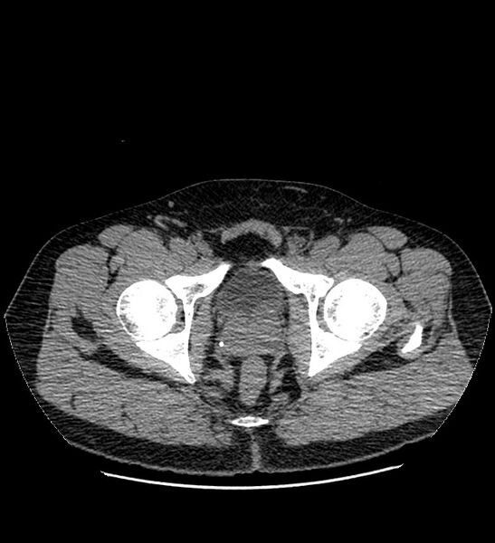 File:Chromophobe renal cell carcinoma (Radiopaedia 84337-99693 Axial non-contrast 156).jpg