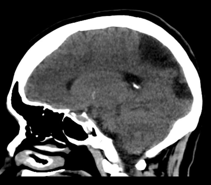 File:Chronic bilateral occipital lobe infarcts (Radiopaedia 31276-31996 C 24).jpg