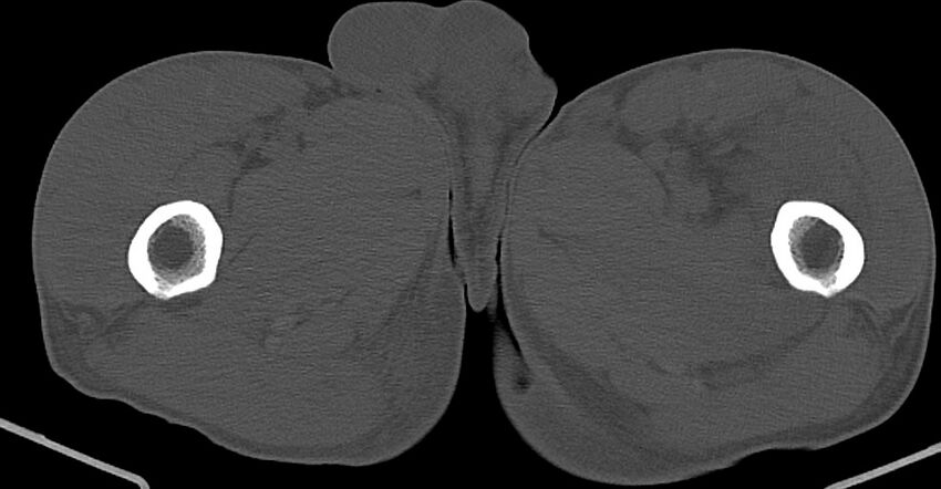 Chronic osteomyelitis (with sequestrum) (Radiopaedia 74813-85822 Axial non-contrast 65).jpg