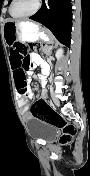 File:Chronic small bowel volvulus (Radiopaedia 75224-86322 C 61).jpg