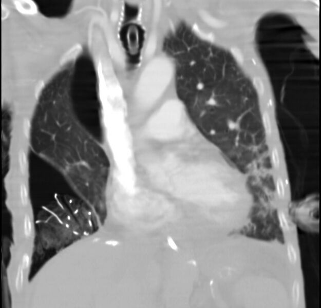 File:Clagett thoracotomy with bronchopleural fistula (Radiopaedia 29192-29587 Coronal lung window 19).jpg