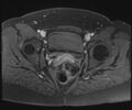 Class II Mullerian duct anomaly- unicornuate uterus with rudimentary horn and non-communicating cavity (Radiopaedia 39441-41755 Axial T1 fat sat 93).jpg