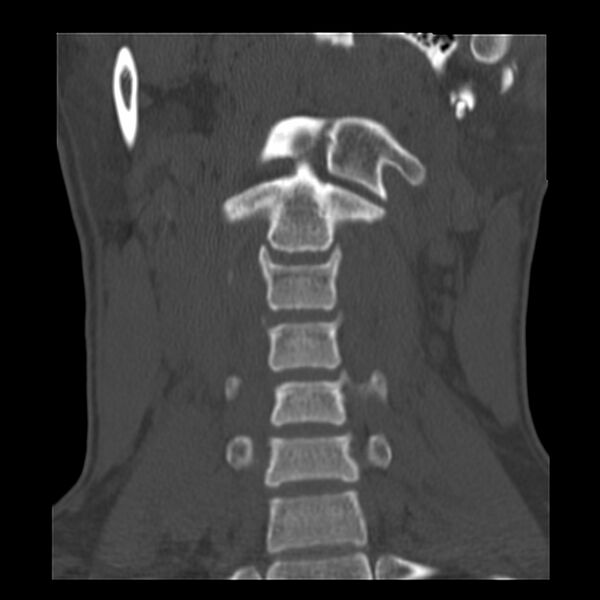 File:Clay-shoveler fracture (Radiopaedia 22568-22590 Coronal bone window 6).jpg