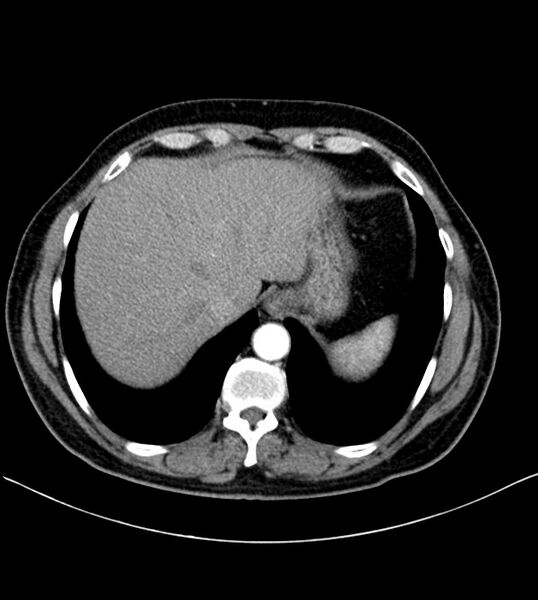 File:Clear cell renal cell carcinoma (Radiopaedia 85006-100539 B 18).jpg