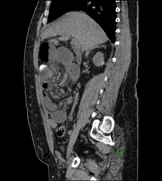 File:Closed-loop small bowel obstruction-internal hernia (Radiopaedia 78439-91096 C 91).jpg