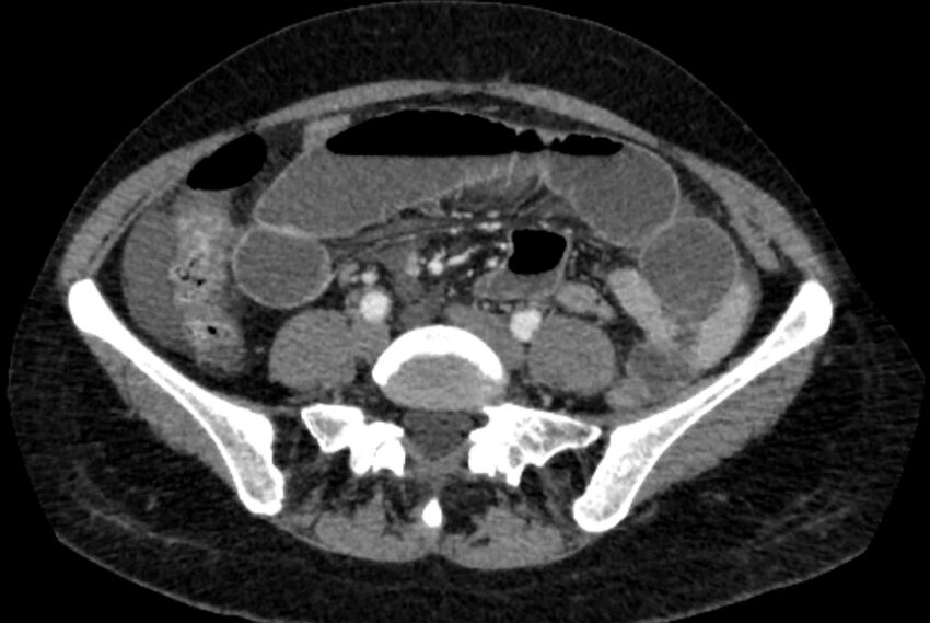 Closed loop small bowel obstruction (Radiopaedia 71211-81508 A 91).jpg