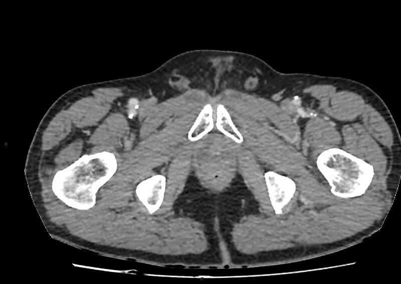 File:Closed loop small bowel obstruction with ischemia (Radiopaedia 84180-99456 A 125).jpg