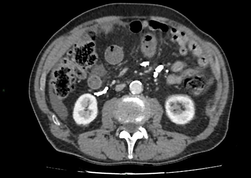 File:Closed loop small bowel obstruction with ischemia (Radiopaedia 84180-99456 A 56).jpg