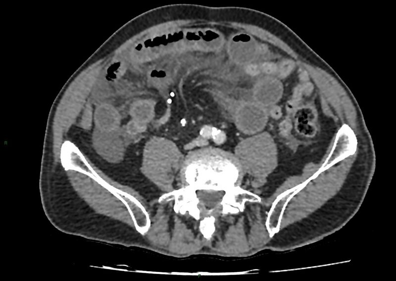 File:Closed loop small bowel obstruction with ischemia (Radiopaedia 84180-99456 A 76).jpg