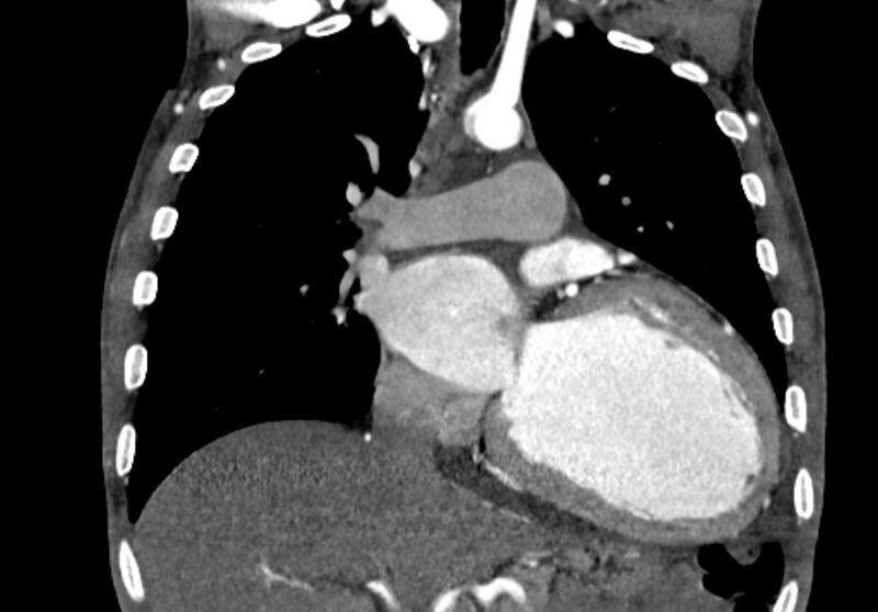 File:Coarctation of aorta with aortic valve stenosis (Radiopaedia 70463-80574 C 102).jpg