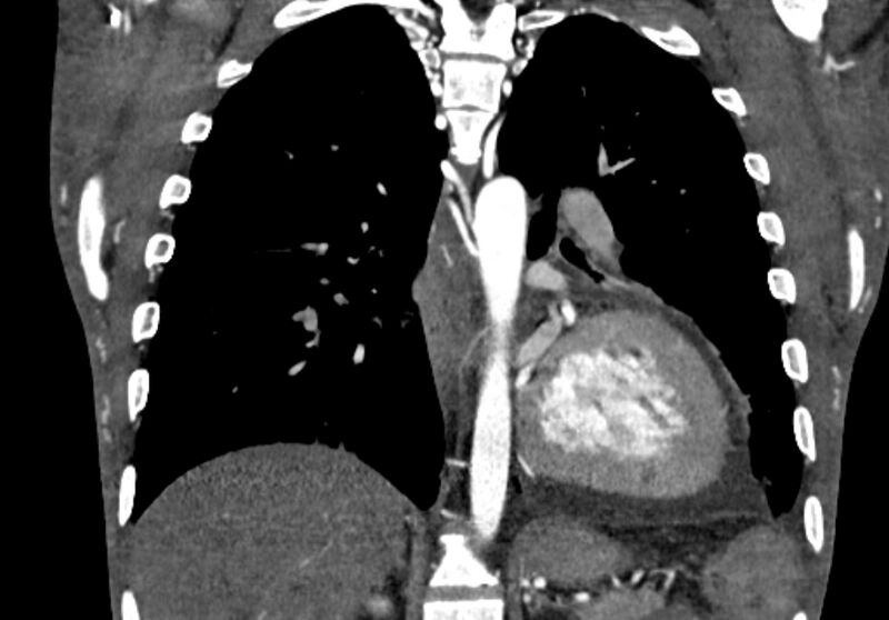 File:Coarctation of aorta with aortic valve stenosis (Radiopaedia 70463-80574 C 159).jpg