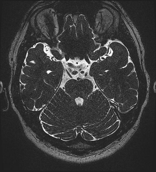 File:Cochlear incomplete partition type III associated with hypothalamic hamartoma (Radiopaedia 88756-105498 Axial T2 121).jpg
