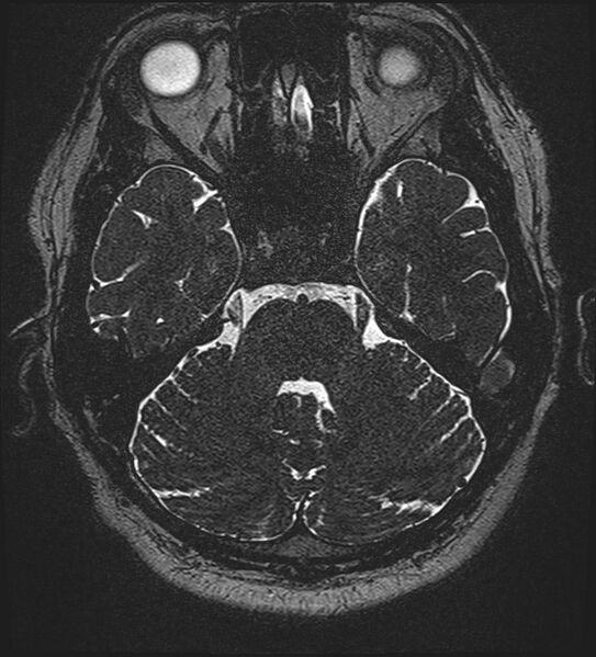 File:Cochlear incomplete partition type III associated with hypothalamic hamartoma (Radiopaedia 88756-105498 Axial T2 99).jpg