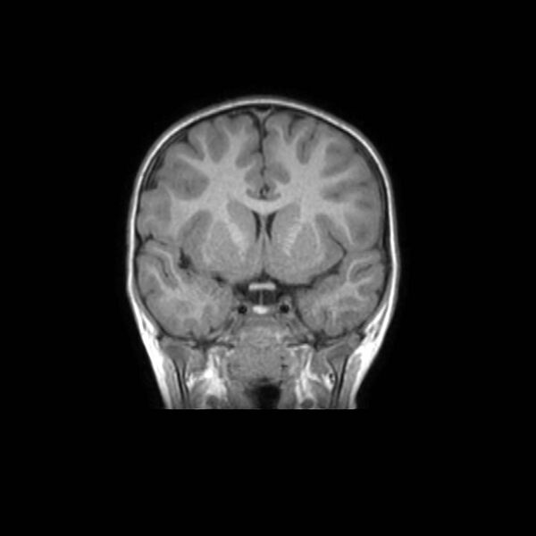 File:Cochlear nerve aplasia - unilateral (Radiopaedia 87910-104413 Coronal T1 22).jpg
