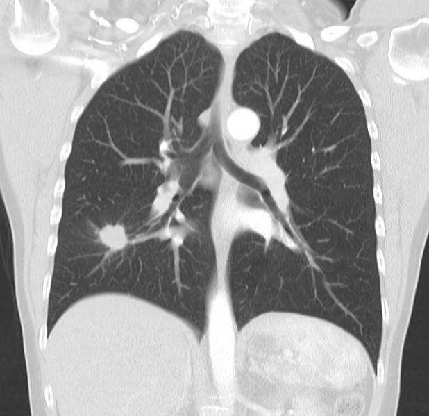 File:Coin lesion - lung adenocarcinoma (Radiopaedia 29787-30308 Coronal lung window 1).png