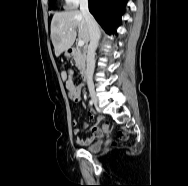 File:Colon carcinoma with hepatic metastases (Radiopaedia 29477-29961 C 24).jpg