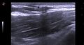 Distal catheter of VP shunt detected by breast ultrasound (Radiopaedia 51009).jpg