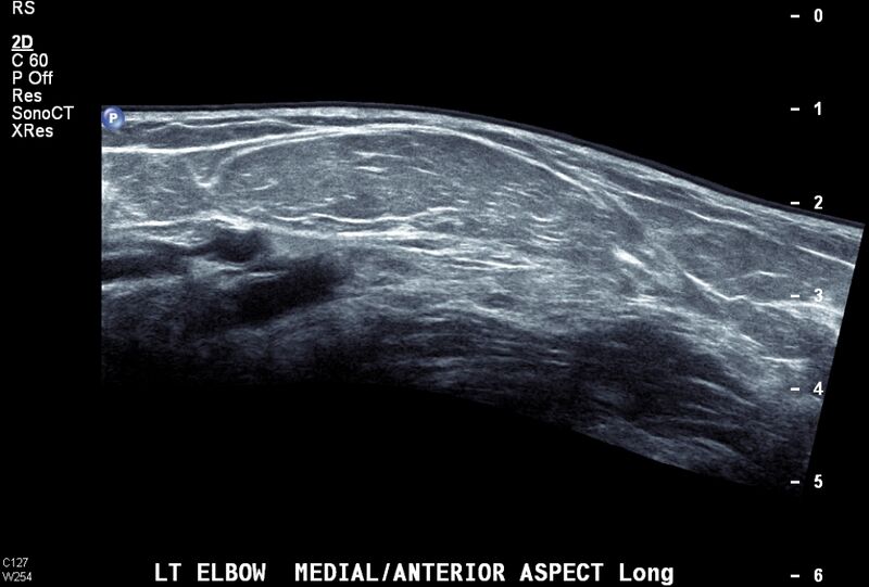 File:Elbow lipoma (Radiopaedia 19139).jpg